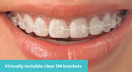 QuickStraightTeeth - Almost invisible braces for adults. Affordable. Fast -  Odontologica